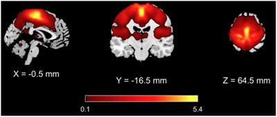 Dynamic spectral signatures of mirror movements in the sensorimotor functional connectivity network of patients with Kallmann syndrome